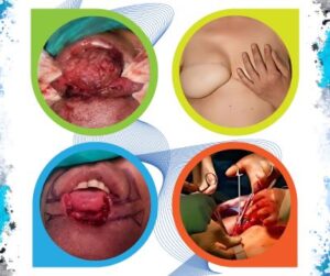 “Dr. Sarvesh Gupta – Cancer Surgeries and Awareness Activities”